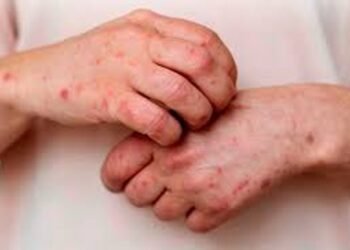 Argentina suma 3 nuevos casos de Mpox y alcanza un total de 11