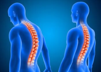 Escoliosis: Deporte y chequeos, claves para el desarrollo saludable de los jóvenes