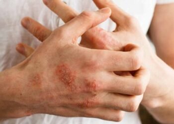 ANMAT da luz verde a nueva terapia oral para artritis psoriásica en adultos