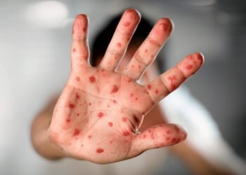 Argentina suma 4 nuevos casos de Mpox y alcanza un total de 15 en 2023