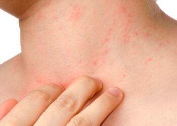 La dermatitis atópica en la infancia: un predictor de asma y alergias futuras