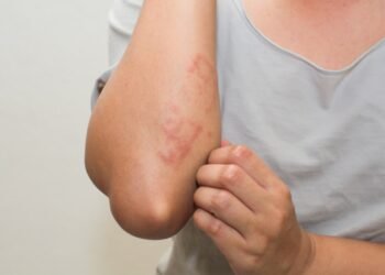 Dermatitis atópica: un desafío constante en la vida diaria