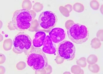 La mayoría de los pacientes con leucemia linfocítica crónica desconoce sus síntomas