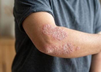 La psoriasis: una enfermedad que va más allá de la piel